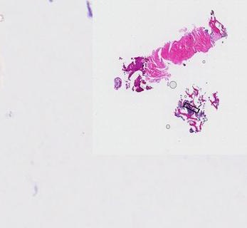 Overview of the whole slide: two tissue fragments on a pale background, with a box marking the magnified area.
