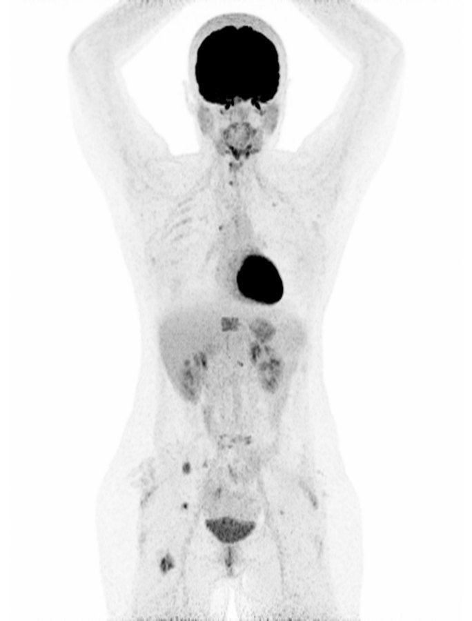 MIP · ¹⁸F-FDG (glucólisis)