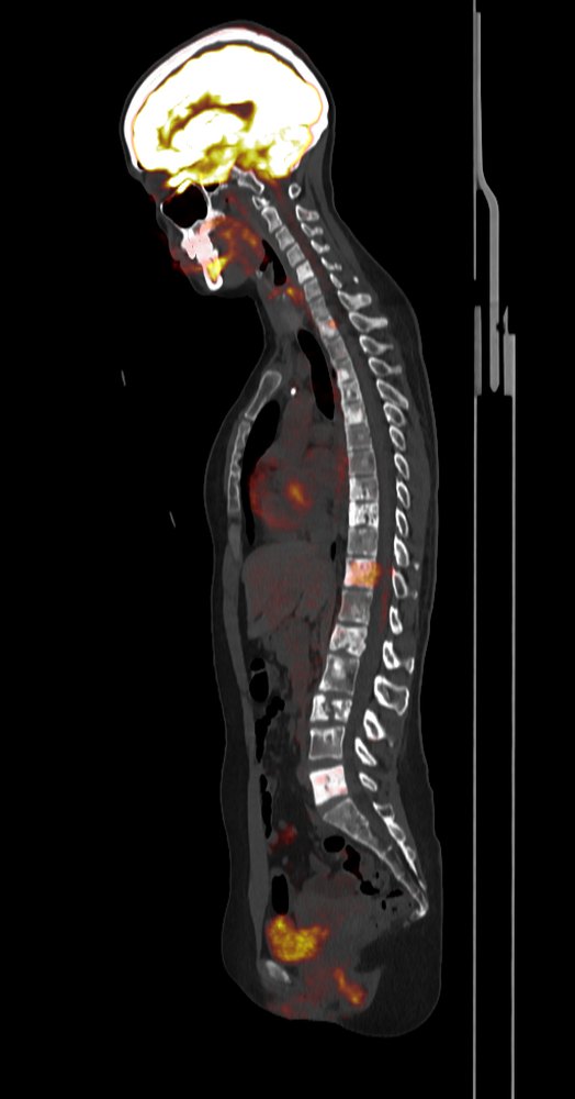 Columna sagital · ¹⁸F-FDG (glucólisis)