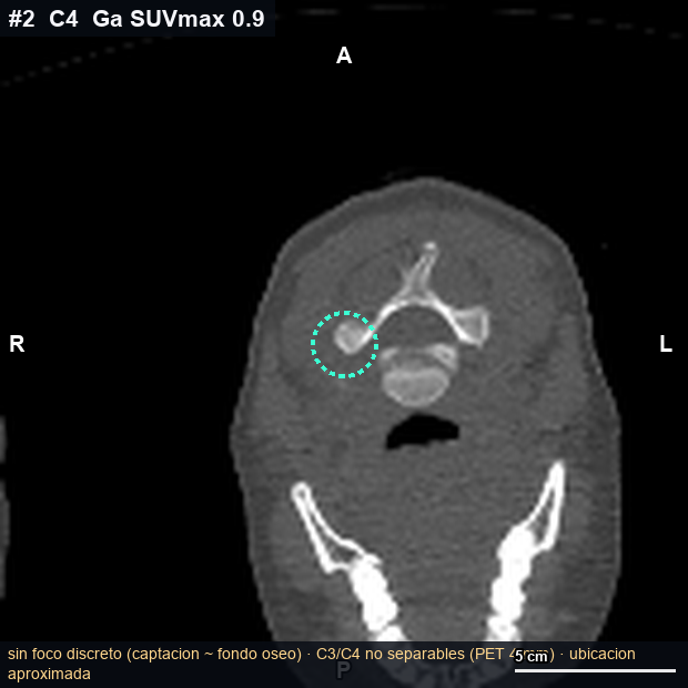 Imagen clave (axial) del foco #2 · C4 · lámina / arco derecho