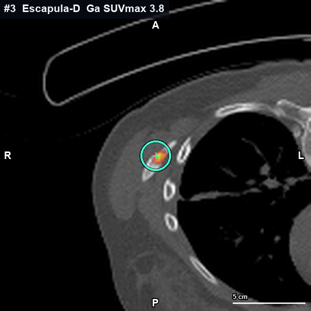 Imagen clave (axial) del foco #3 · Escápula derecha