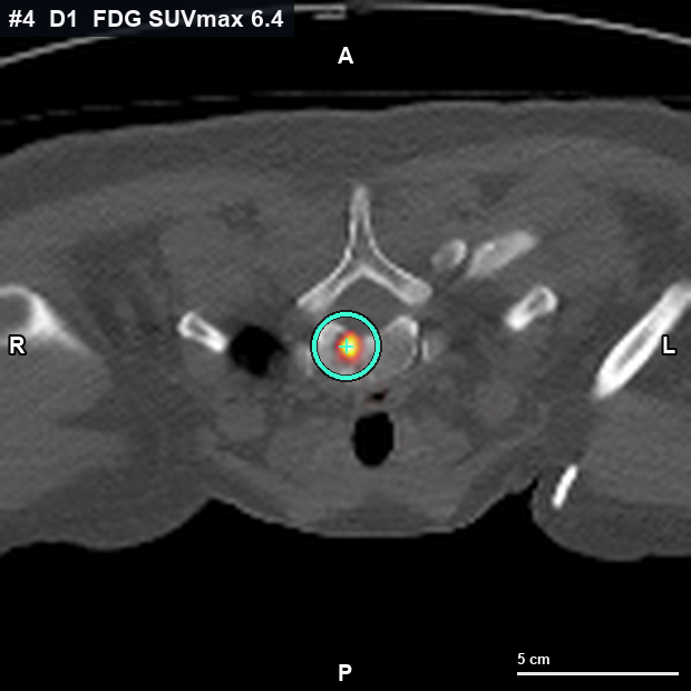 Imagen clave (axial) del foco #4 · D1 (T1) · cuerpo vertebral