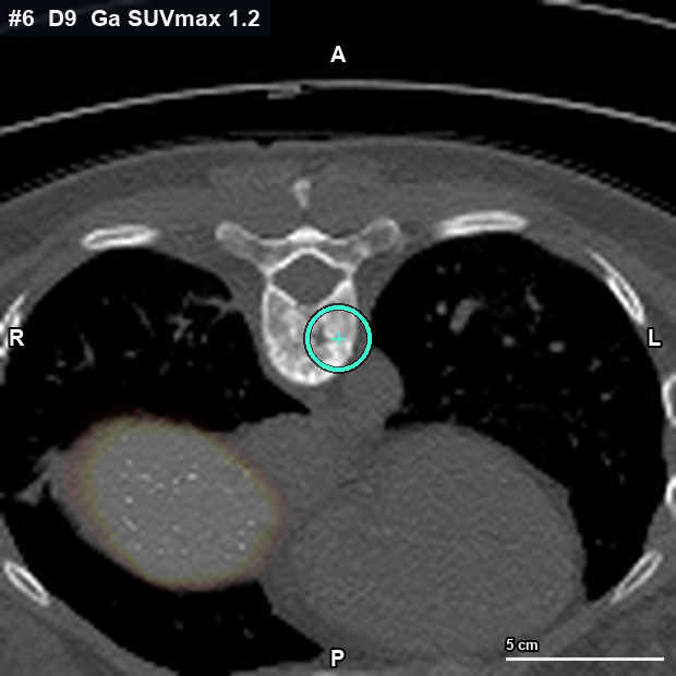 Imagen clave (axial) del foco #6 · D9 (T9) · cuerpo derecho