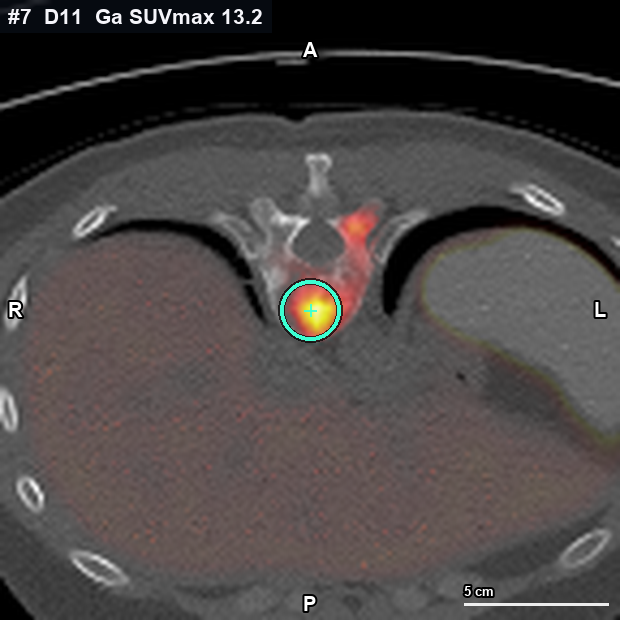 Imagen clave (axial) del foco #7 · D11 (T11) · cuerpo vertebral
