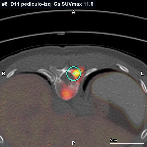 Imagen clave (axial) del foco #8 · D11 (T11) · pedículo izquierdo