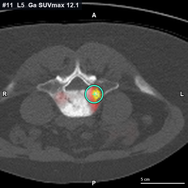 Imagen clave (axial) del foco #11 · L5 · cuerpo vertebral