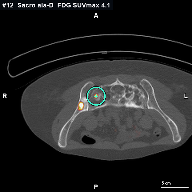 Imagen clave (axial) del foco #12 · Ala sacra derecha