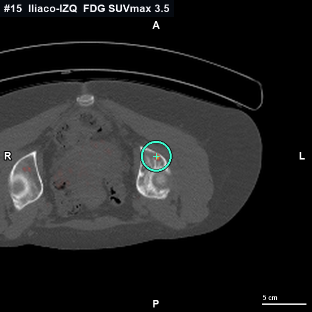 Imagen clave (axial) del foco #15 · Ilíaco izquierdo supraacetabular