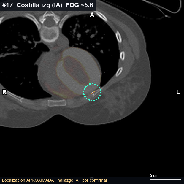 Imagen clave (axial) del foco #17 · Tórax alto / costilla