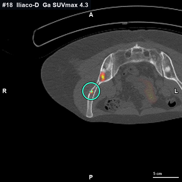 Imagen clave (axial) del foco #18 · Ilíaco derecho · unión ilíaco-femoral