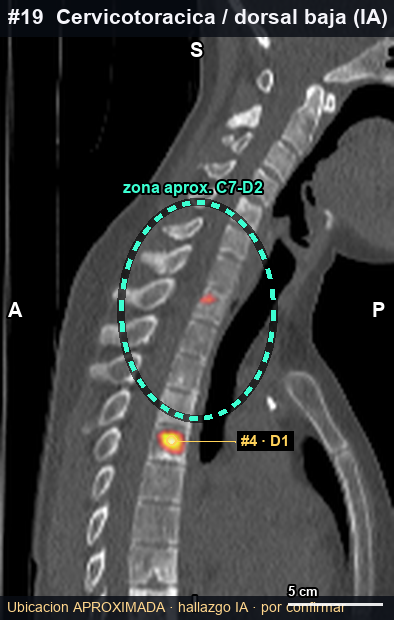 Imagen clave (axial) del foco #19 · C7–D2 · transición cervicotorácica