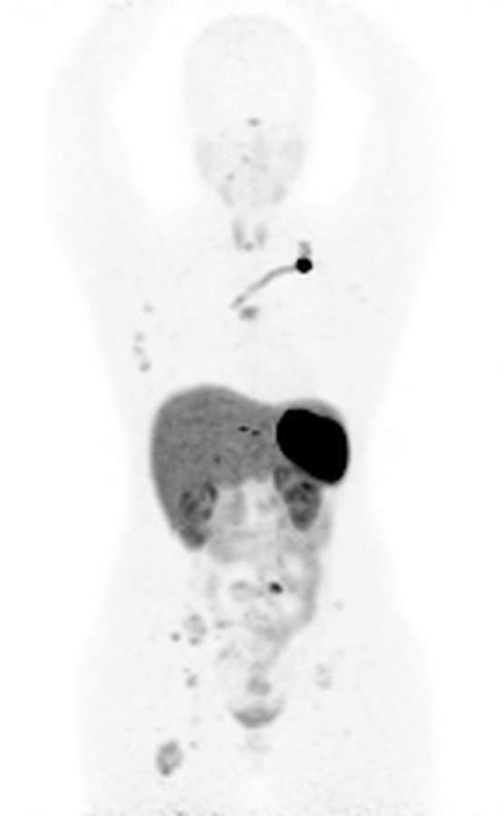 MIP · ⁶⁸Ga-DOTATOC (SSTR)