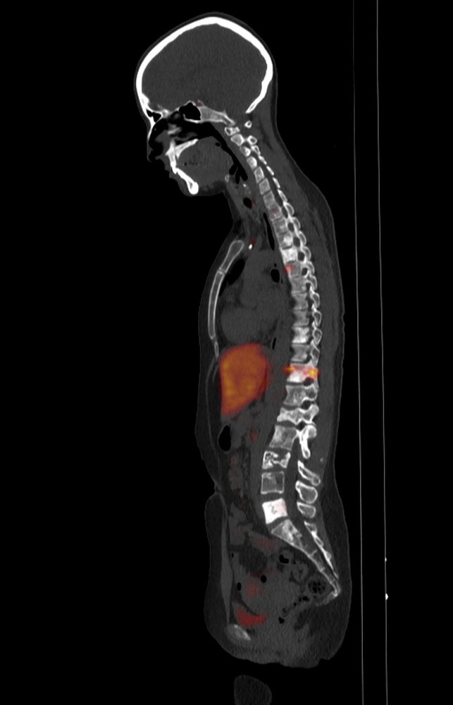 Columna sagital · ⁶⁸Ga-DOTATOC (SSTR)